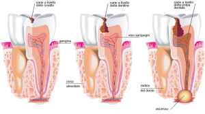 EVOLUZIONE CARIE - CLINIC TORINO